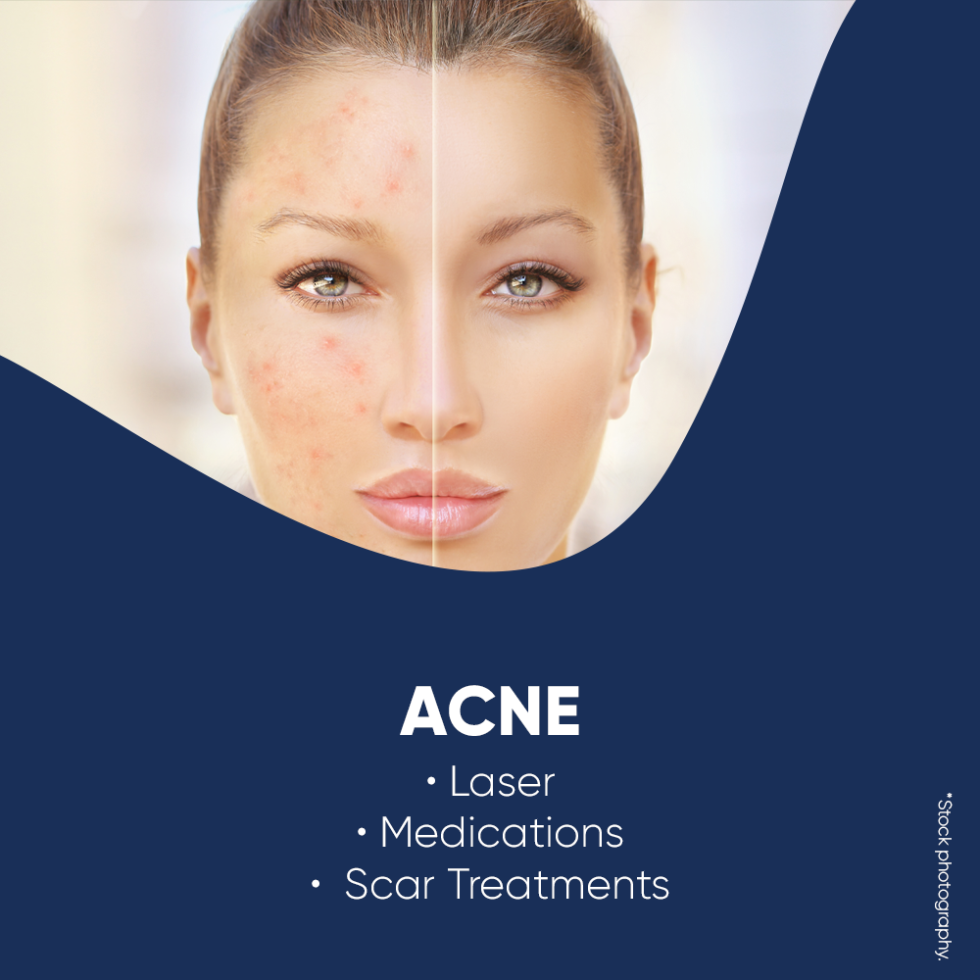 Acne Treatments Chatswood - Aurora Dermatology