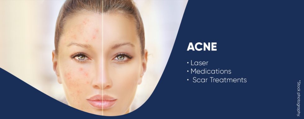 Acne Scar Laser Treatment - Aurora Dermatology